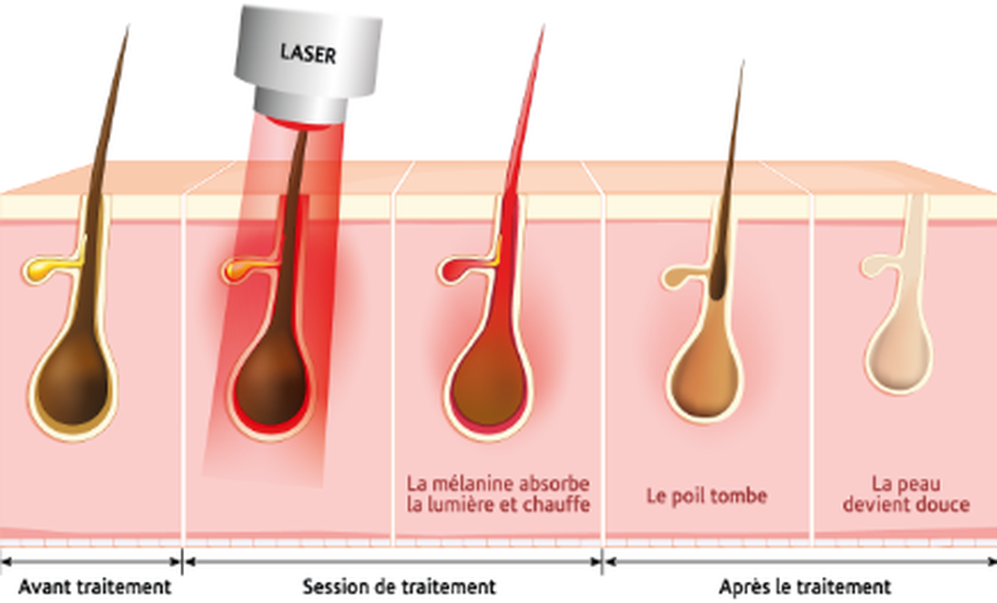 Schéma expliquant comment le laser agit sur le poil